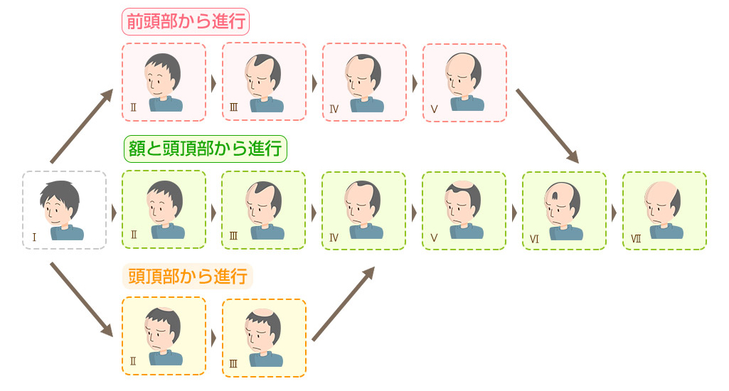 男性の薄毛の振興パターン