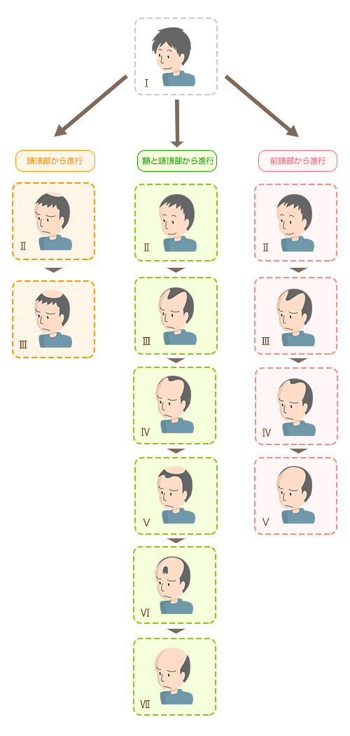 男性の薄毛の振興パターン